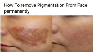 How To Remove Pigmentation From Face permanently