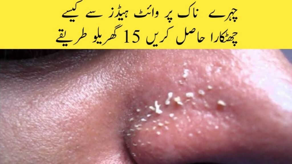 How To Get Rid OF White Heads On Face Nose |15 Ways Home