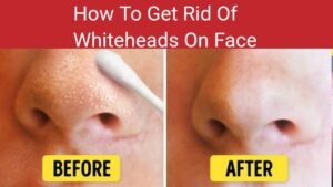 How To Get Rid OF White Heads On Face Nose |15 Ways Home